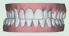Illustration of crossbite, where upper and lower jaws are misaligned, resulting in one or more upper teeth biting on the inside of lower teeth, leading to tooth wear, gum disease, and bone loss.