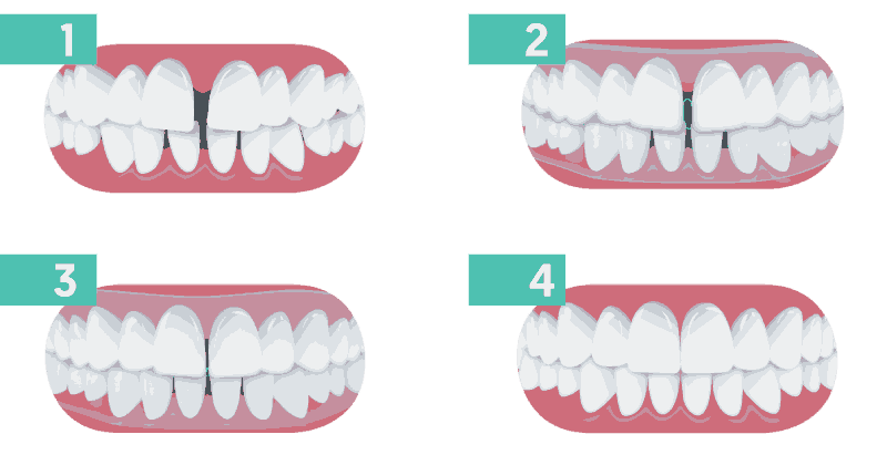 The Four Stages of Clear Correct Aligner treatment