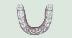 Illustration of overly crowded teeth, causing lack of room in the jaw, leading to dental decay, increased risk of gum disease, and impaired tooth function.