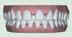 Image showing widely spaced teeth caused by abnormal jaw bone growth or missing teeth, potentially leading to spacing issues and periodontal diseases.