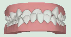 Illustration of underbite, with lower teeth protruding past the front teeth due to undergrowth of the upper jaw, overgrowth of the lower jaw, or missing upper teeth, leading to impaired front teeth and molar function, tooth wear, and painful jaw and joint problems.